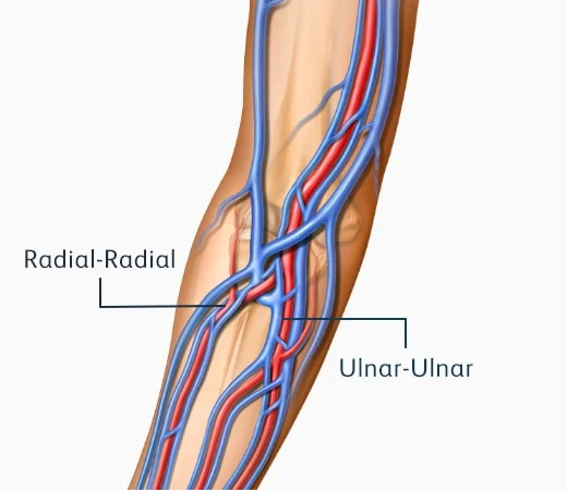 end stage renal disease